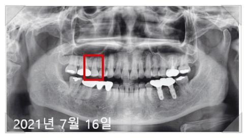 국산임플란트가격? 이 글로 종결합니다. 관련 이미지 2