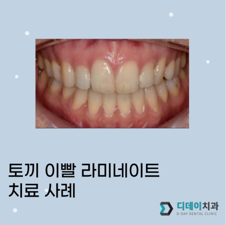 강남 라미네이트 치과? 전문의가 직접 설명드립니다. 관련 이미지 1