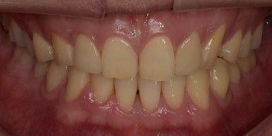작은치아라미네이트, 치아삭제 없이 가능하다? 관련 이미지 8