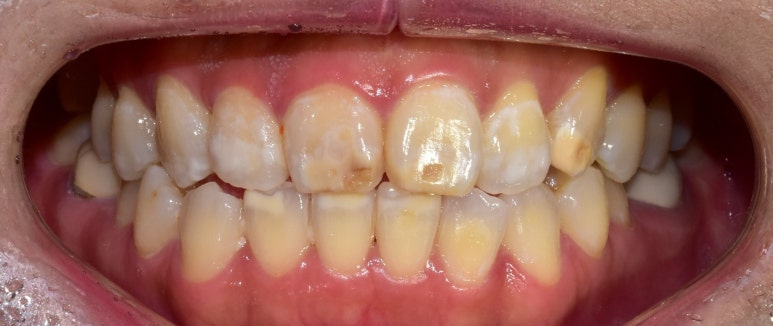 반상치(치아반점)라미네이트, 치료 사례와 비용까지 전격공개 관련 이미지 2