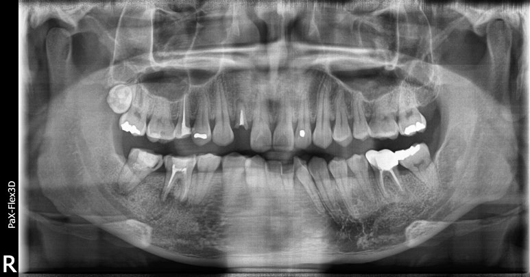 20대임플란트 수명? 평생 못쓸수도 있습니다. 관련 이미지 1