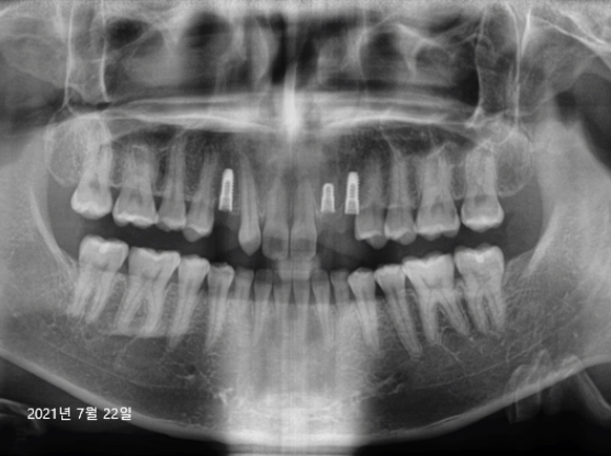 어금니발치후임플란트? 꼭 받아야 할지 궁금한 분은 보세요. 관련 이미지 2