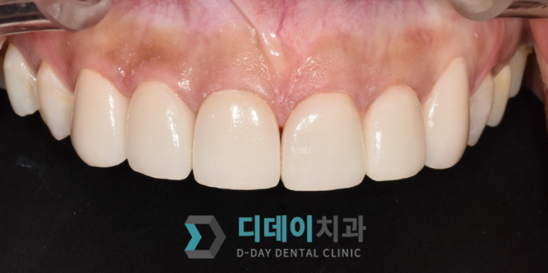 앞니크라운빠짐, 탈락한 경우 재부착 가능할까요? 관련 이미지 5