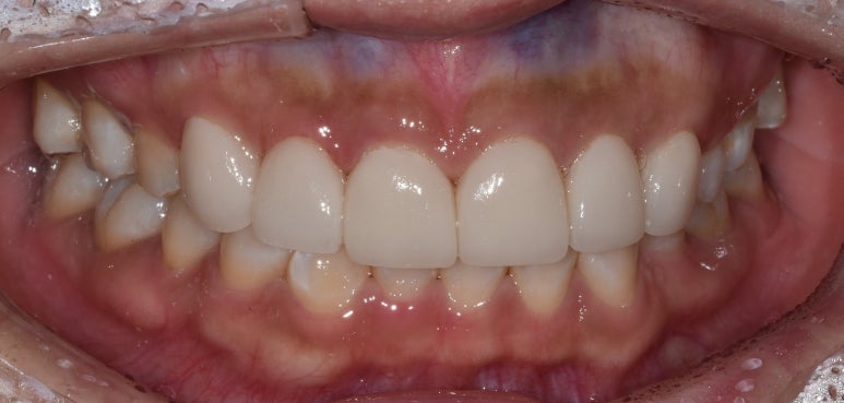 반상치(치아반점)라미네이트, 치료 사례와 비용까지 전격공개 관련 이미지 5