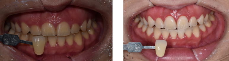 치아미백주의사항과 비용, 셀프미백과의 차이점까지 전부 설명드립니다. 관련 이미지 3