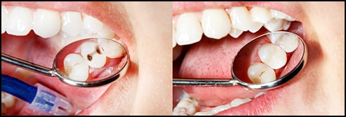 레진 인레이 차이, 치과의사가 알려준다면? 관련 이미지 2
