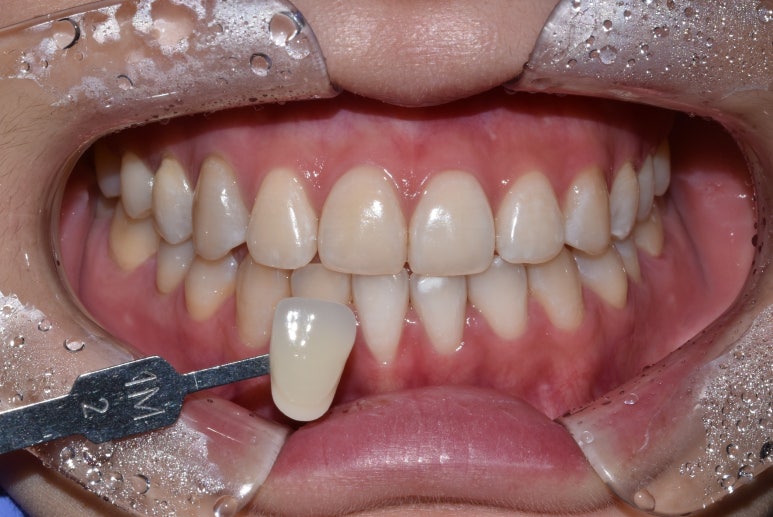 누렁니치아미백, 치료 사례로 보여드리는 개선 효과 관련 이미지 8