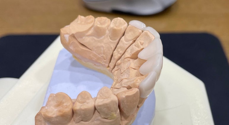 앞니브릿지, 오래된 브릿지교체하신 치료사례와 비용공개합니다. 관련 이미지 10