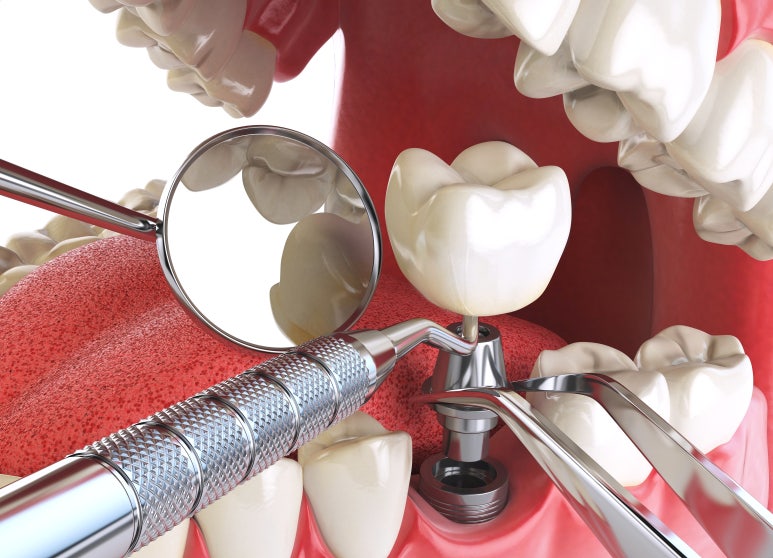 임플란트잘하는병원? 치과의사가 말하는 3가지 특징 관련 이미지 4