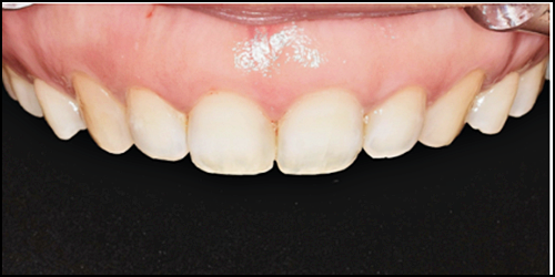 옥니라미네이트, 치과 전문의가 알려드릴께요. 관련 이미지 1