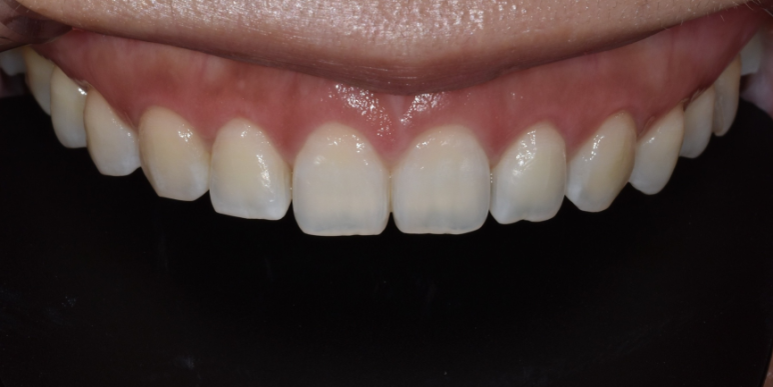 잇몸성형가격? 비용, 주의사항, 치료 후기 공개 관련 이미지 8