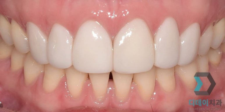 라미네이트후기, 치료사례만 모아 보여드립니다 관련 이미지 4