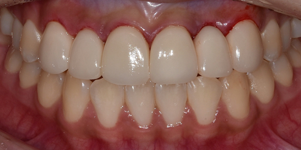 치은절제술/성형술? 잇몸이 치아를 덮고 있어 고민인 분만 관련 이미지 10