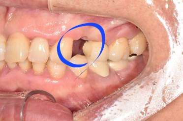 국산임플란트를 선택한 이유, 치료사례 공개합니다 관련 이미지 9
