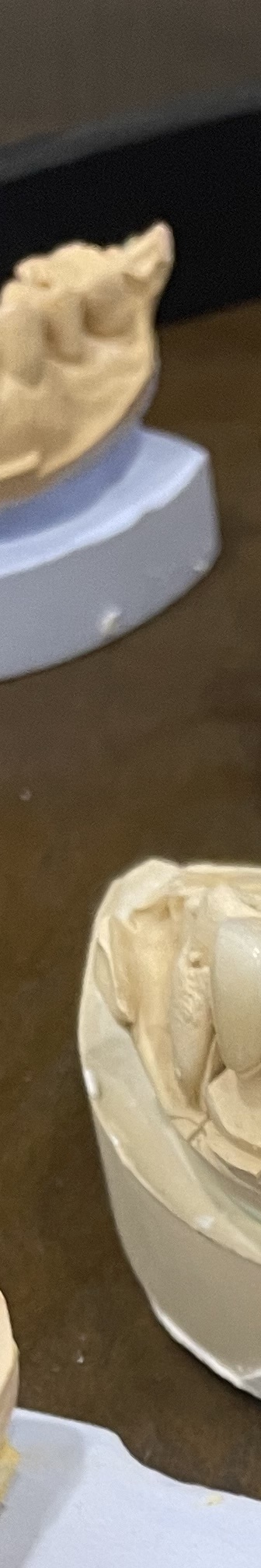 매봉역 치과, 자연치아 잃고 싶지 않다면? 관련 이미지 8