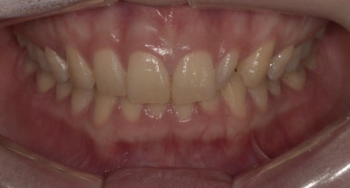 작은치아라미네이트, 치아삭제 없이 가능하다? 관련 이미지 2