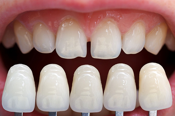 무삭제 라미네이트, 장점과 단점 전문의가 설명드립니다. 관련 이미지 5