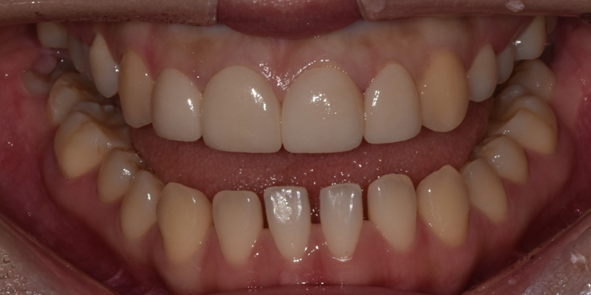 벌어진치아 교정 없이 라미네이트로 치료한 사례와 비용까지 관련 이미지 5