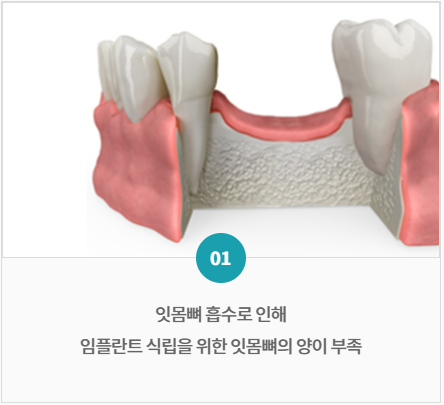 내몸에 들어갈 임플란트뼈이식 재료와 비용, 제대로 알고 계신가요? 관련 이미지 3