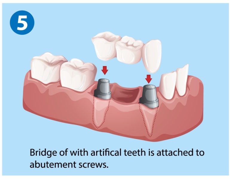 임플란트브릿지? 치아 개수대로 임플란트 심지 않아도 됩니다 관련 이미지 4
