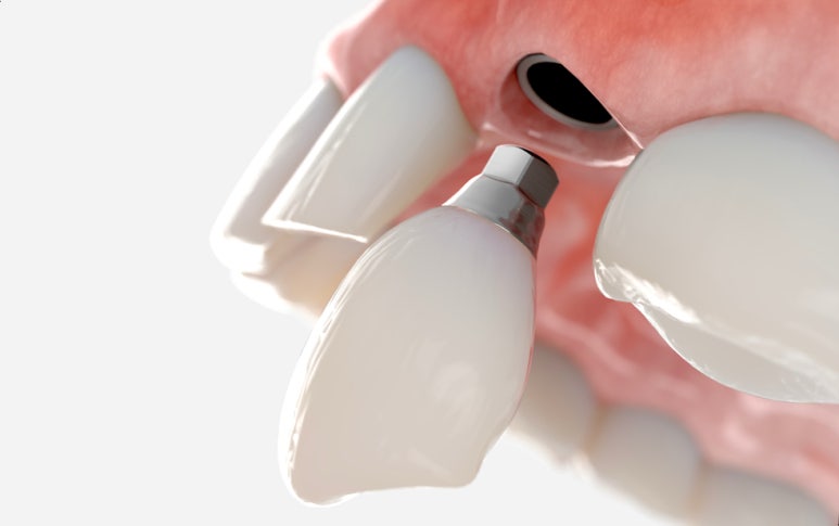 앞이빨임플란트, 내 치아처럼 감쪽같으려면? 관련 이미지 5