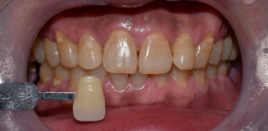 승무원 치아미백, 그 비결이 궁금하다면? 관련 이미지 1