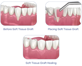 잇몸퇴축수술 , 실패 확률을 최소화하는 5가지 핵심 사항 관련 이미지 3