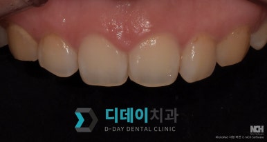 Gangnam Gum Contouring—Doesn’t It Hurt? An Honest Account of the Pain image 9