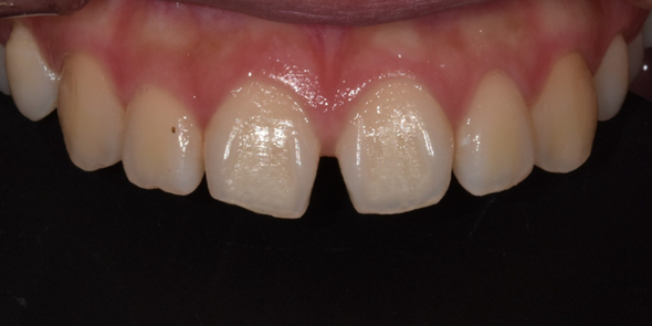 벌어진앞니 레진치료 사례, 비용 및 라미네이트와의 차이점 비교 관련 이미지 3