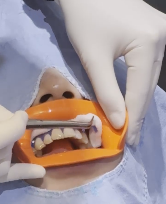 선릉역치과, 치아미백 후기보다 중요한 것 2가지 관련 이미지 3