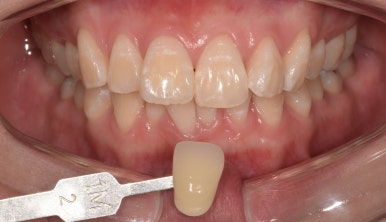 [진심인터뷰] &ldquo;한국까지 와서 원데이치아미백 했어요&rdquo; - 일본에서 온 두 친구 이야기 관련 이미지 3