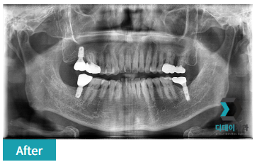 삼성역 임플란트, 이 글만 읽어보셔도 충분합니다. 관련 이미지 4