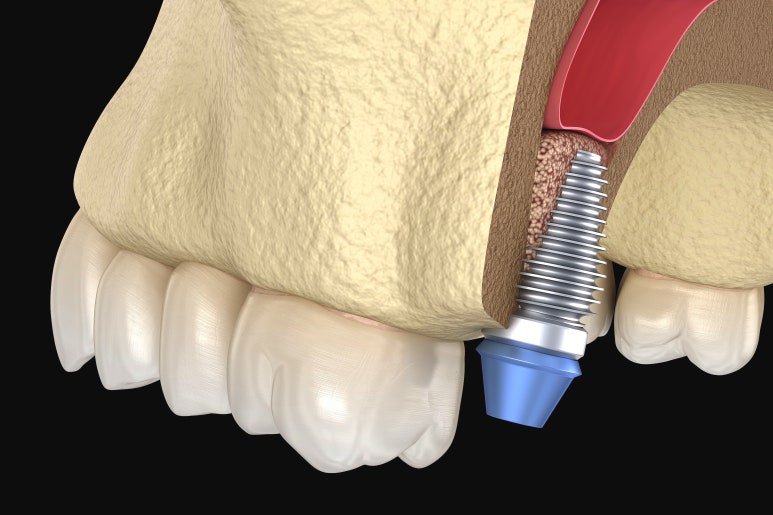 임플란트흡연, 무조건 2주는 참아야 하는 이유 관련 이미지 2