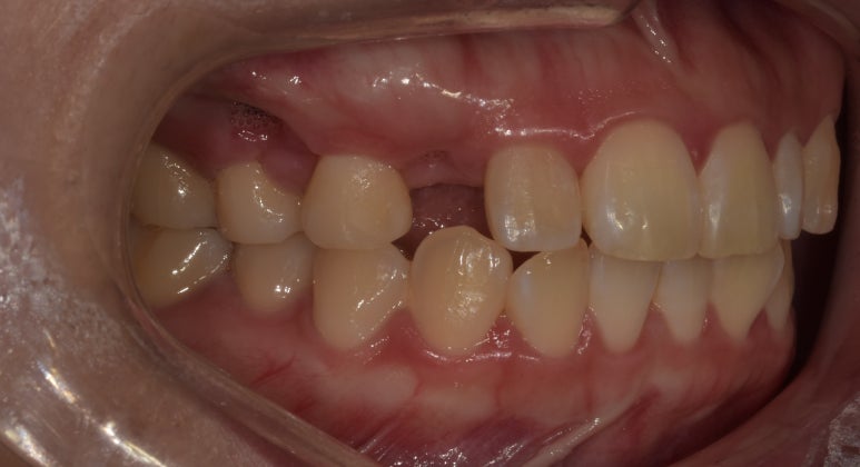 앞니브릿지와 라미네이트를 같이 해도 자연스러울까? 사례로 보여드립니다. 관련 이미지 4