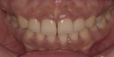 [진심인터뷰] &ldquo;잇몸성형, 안 할 이유가 1도 없어요&rdquo; 예비신부의 후기 관련 이미지 7