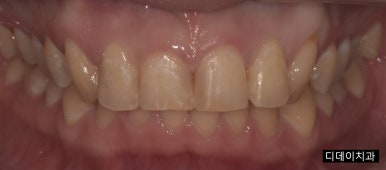 치아레진? 앞니, 치경부, 어금니 각 부위별 치료사례&비용 관련 이미지 5