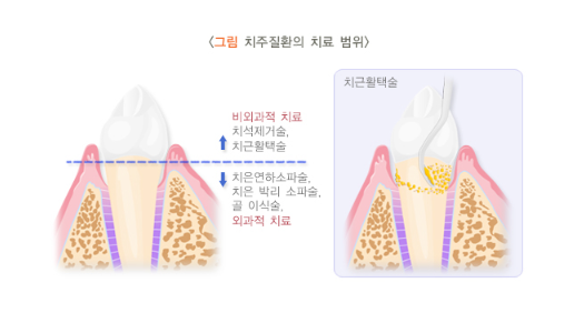 교대역치과 잇몸이 내려가서 뿌리가 보인다면, 지금 이 순간이 골든타임입니다 관련 이미지 2