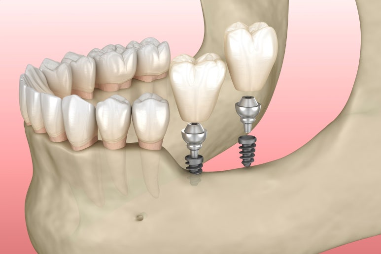 임플란트상악동거상술, 통증은 OO 때문이다? 관련 이미지 1