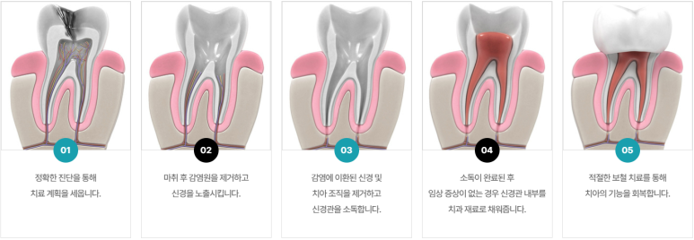 신경치료아픈가요? 이 글 보시면 통증 두려움 없어집니다. 관련 이미지 5