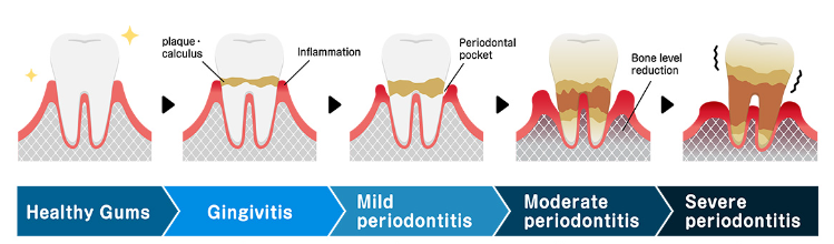 치아미백 지속기간,가격, 부작용, 횟수, 총정리 해드립니다. 관련 이미지 3