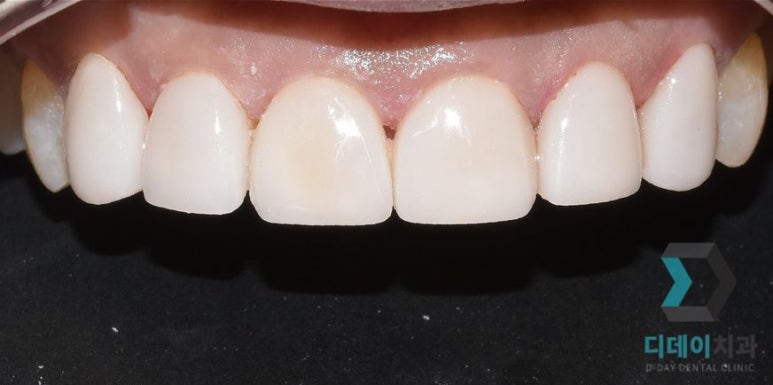 치아성형 종류, 비용, 장단점까지 완벽정리 관련 이미지 8