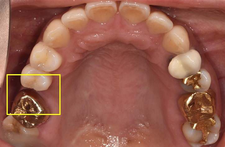 어금니 발치후 임플란트 기간? 식립 시기 모르면 후회합니다 관련 이미지 7