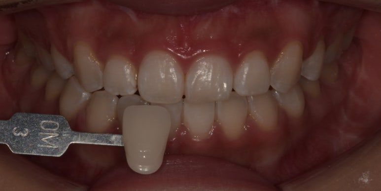 치과치아미백, 전후사진과 치료비용이 궁금하다면? 관련 이미지 6