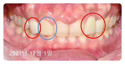 네비게이션임플란트비용? 대표원장이 솔직하게 공개합니다. 관련 이미지 2