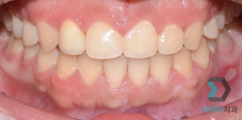작은이빨, 왜소치? 치아 크기를 키우고 싶은 분만 <필독> 관련 이미지 10