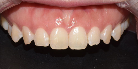 잇몸절제? 절개없이 레이저로 잇몸성형한 후기 관련 이미지 3