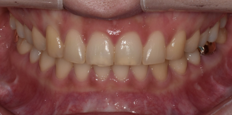 교정후라미네이트? 실제 치료 후기 궁금하신 분만 관련 이미지 8