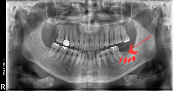 국산임플란트를 선택한 이유, 치료사례 공개합니다 관련 이미지 2