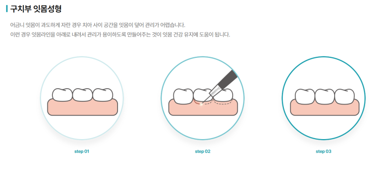 치은성형술, 잇몸이 너무 많이 보여서 웃기 싫었다면 의사 작성 관련 이미지 3