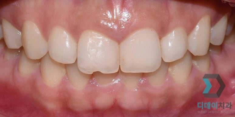 라미네이트후기, 치료사례만 모아 보여드립니다 관련 이미지 17